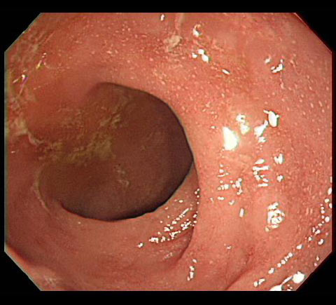 潰瘍性大腸炎