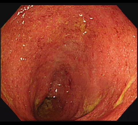潰瘍性大腸炎