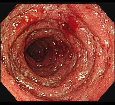 潰瘍性大腸炎