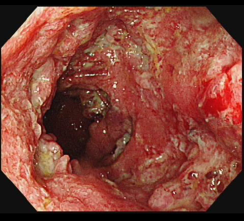 潰瘍性大腸炎