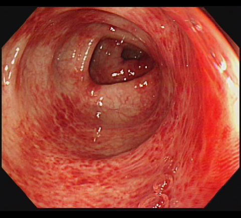 虚血性大腸炎