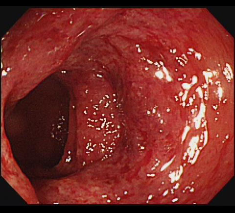 虚血性大腸炎