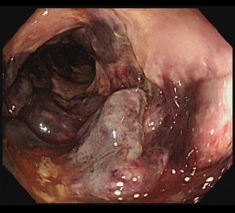 虚血性大腸炎
