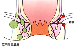 痔瘻（アナ痔）と肛門周囲膿瘍