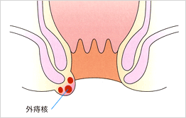 外痔核