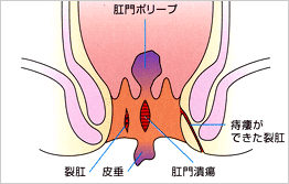 裂肛（キレ痔）