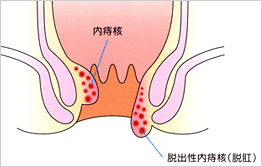 内痔核